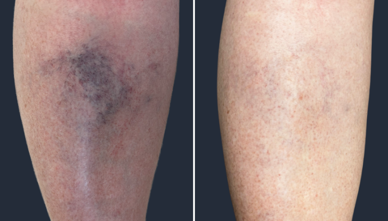 Spider Veins, 2 Months